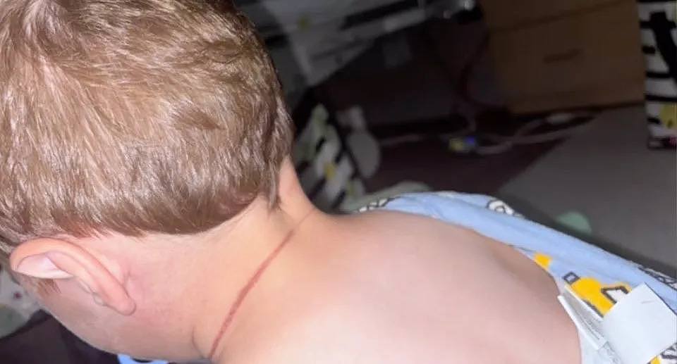 The boy has a deep red mark wrapped around his neck where the hair strangled him. 