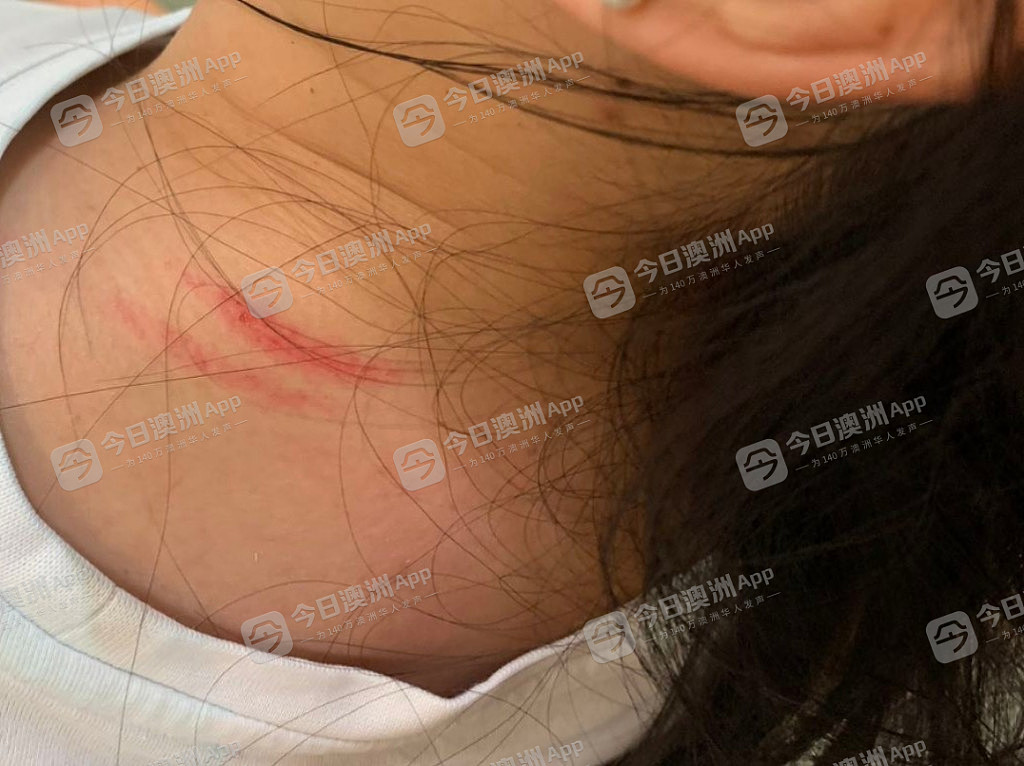中国女留学生在阿德乘公车遇种袭，遭恶少群起围攻！多处受伤无人援手，“安全感为零！”（视频/组图） - 1