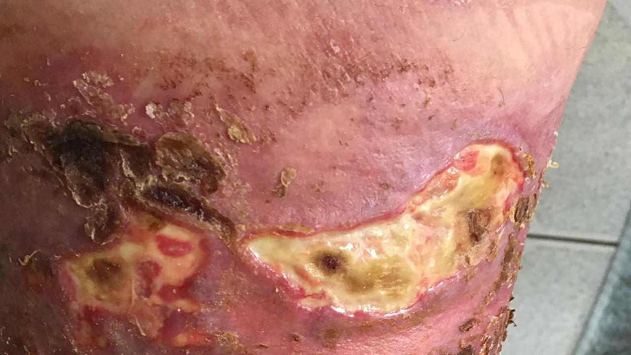 Celeste Stirrup's leg infection. Picture - contributed.
