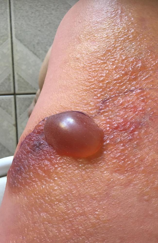 Celeste Stirrup's leg infection. Picture - contributed.