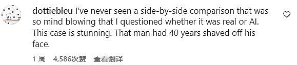 中年男子接受整容手术，前后对比照震惊网友：这绝对不是同一个人（组图） - 7