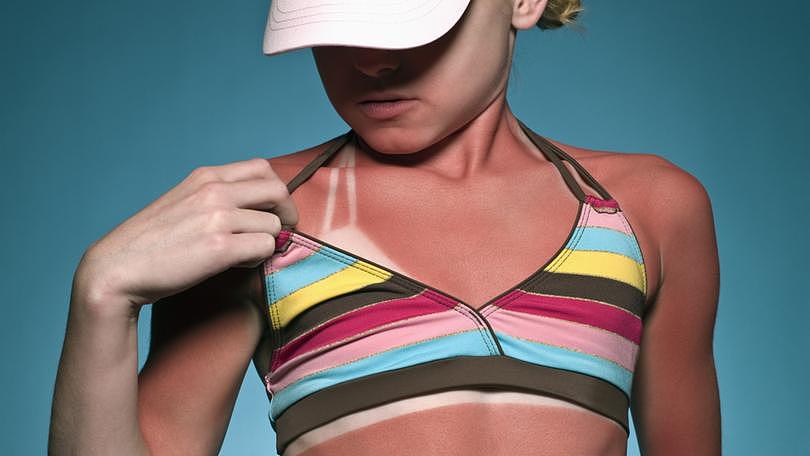 Presentations to the emergency department for young West Australians aged between 10 and 19 with severe sunburn has more than doubled in a decade.