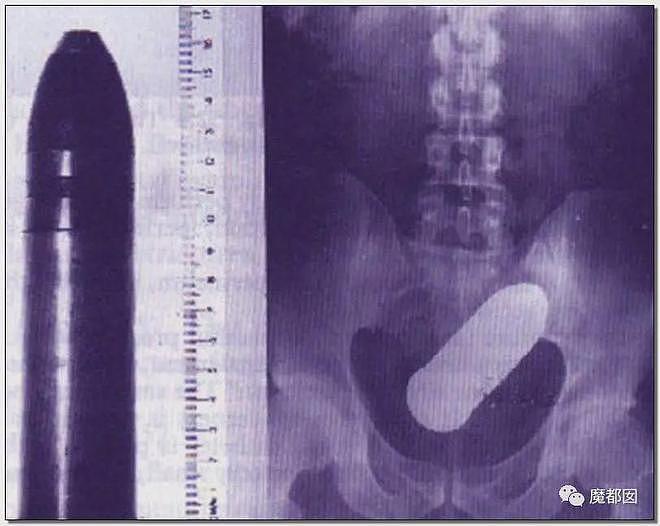 震撼！茄子，台球，磁力珠……你们不要什么东西都乱塞（组图） - 96
