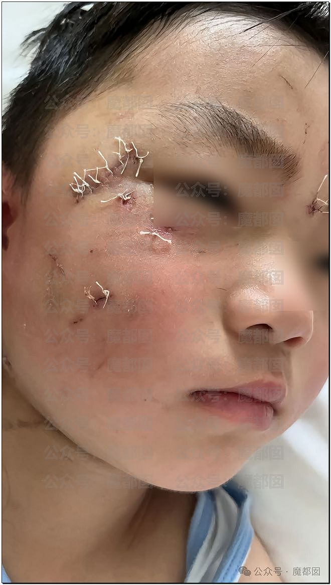 全网震怒！3岁孩子被哈士奇咬伤，打疫苗后狂犬病发作身亡（组图） - 69