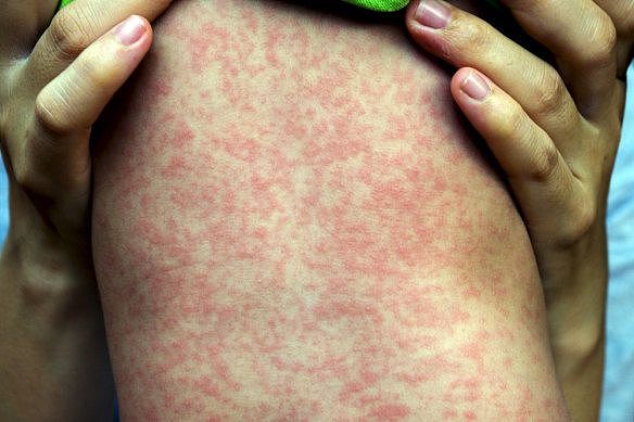 Measles cases are on the rise globally as authorities warn Australians to make sure they are up-to-date with vaccinations.