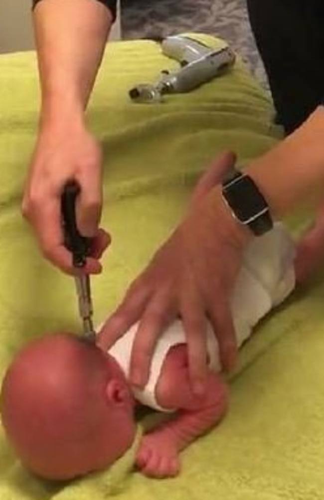 Dr Andrew Arnold uses a tool he describes as an “activator” on the baby. Picture: Supplied