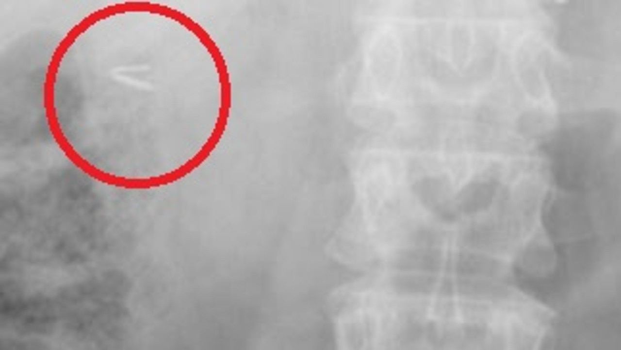 A woman allegedly had a metal clip inside her body for more than 20 years.