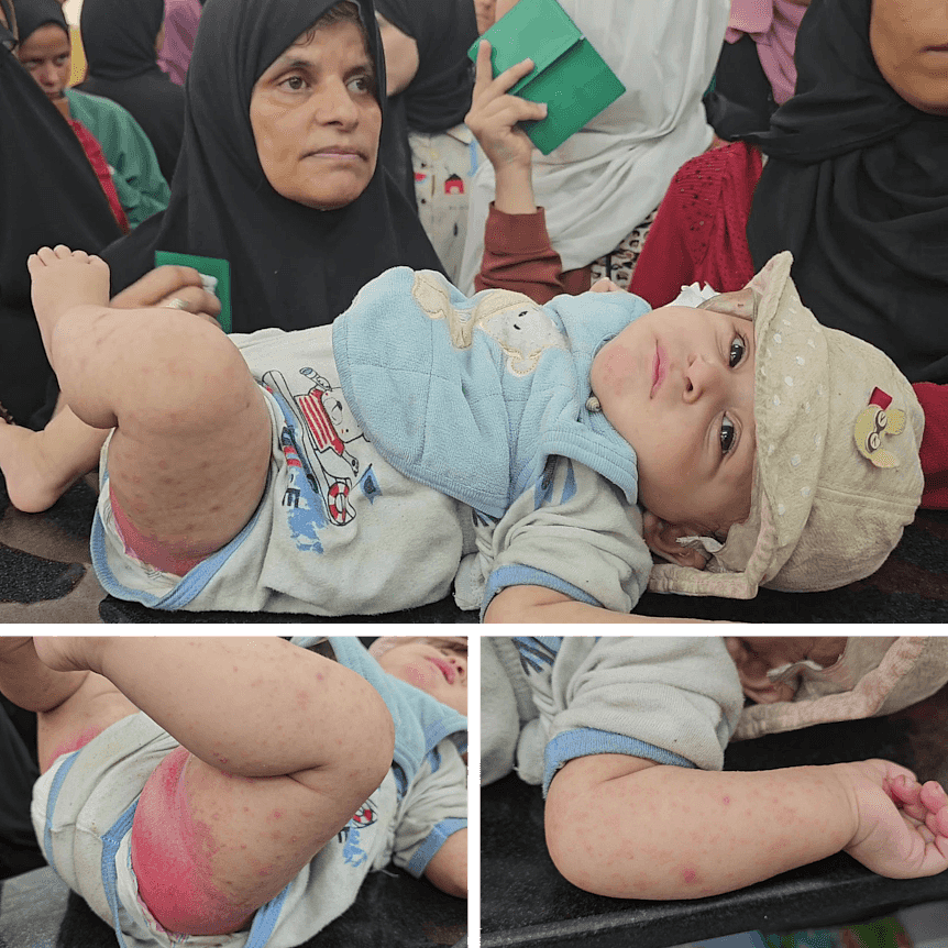 A woman wearing hijab stands behind a baby who has a red rash under his leg