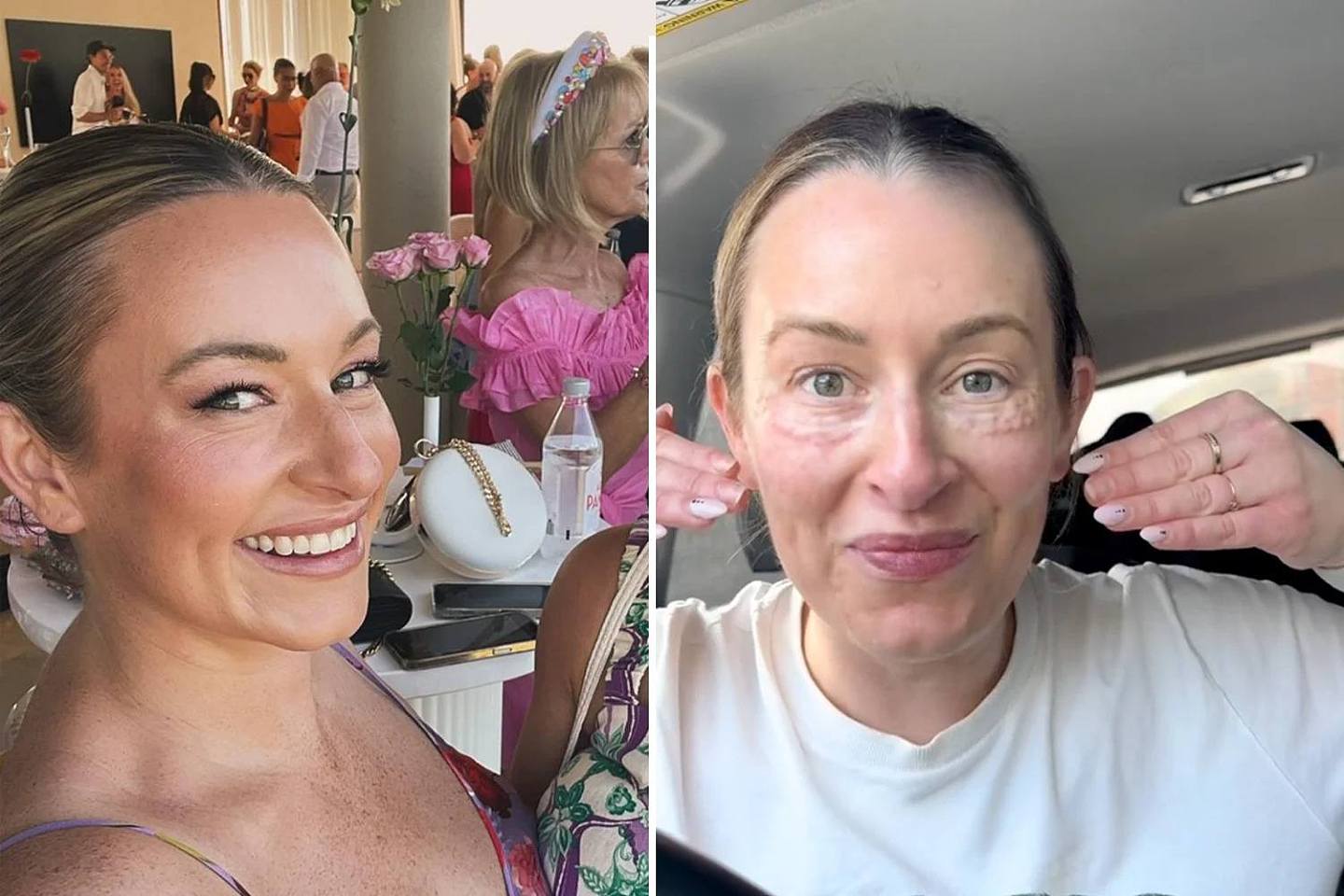 Nicole Sherwin smiles at a wedding while wearing a dress (left) and she sits in her car pointing at her face with bumps under her skin just after receiving the 'salmon sperm' injectable in Melbourne (right). 