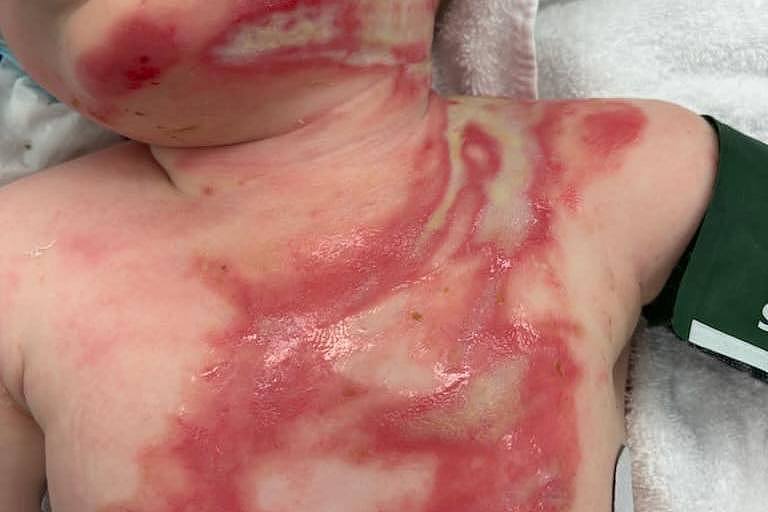 Burns on the body of a baby.