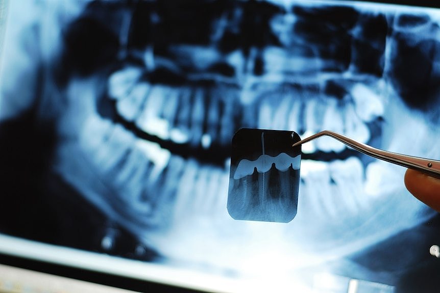 Dental xray illuminated on a light screen.