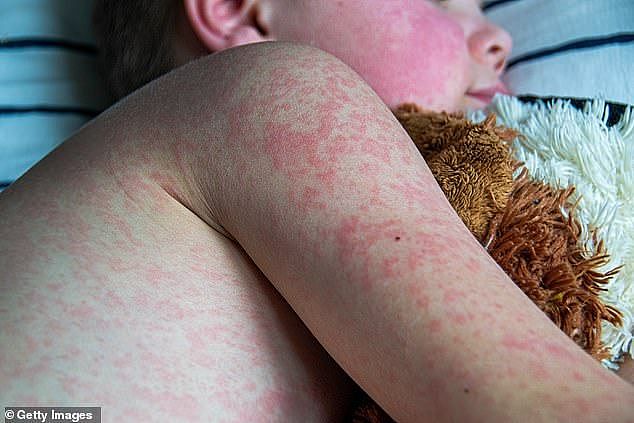 Passengers who were on flight SQ225 Singapore to Perth on Sunday are being warned to look for measles symptoms (stock image of measles)