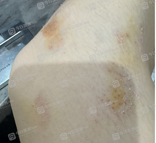 “一脚把我踹下电梯!”澳洲华人女孩当众被殴抢,市区火车站众人冷漠!“很多人,看着我倒在地上流血”(组图) - 3