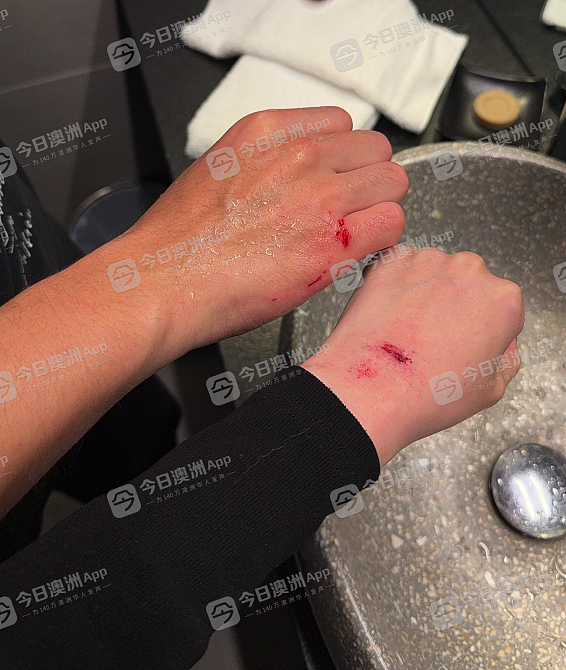 烟头烫脸、当街拖行！中国夫妻游澳洲，市中心无端遇袭被打伤！施暴者为两少女，已被起诉（视频/图片） - 5