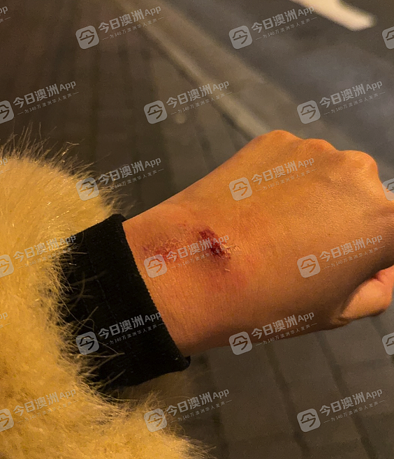烟头烫脸、当街拖行！中国夫妻游澳洲，市中心无端遇袭被打伤！施暴者为两少女，已被起诉（视频/图片） - 6