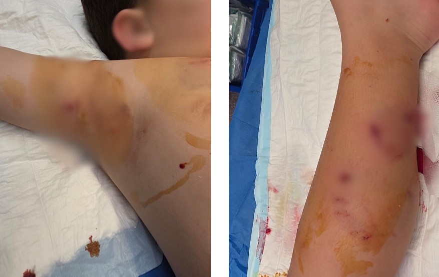 悉尼热门公园出事！4岁男童惨遭恶犬袭击，全身多处被咬伤，狗主人仍在逃（组图） - 2