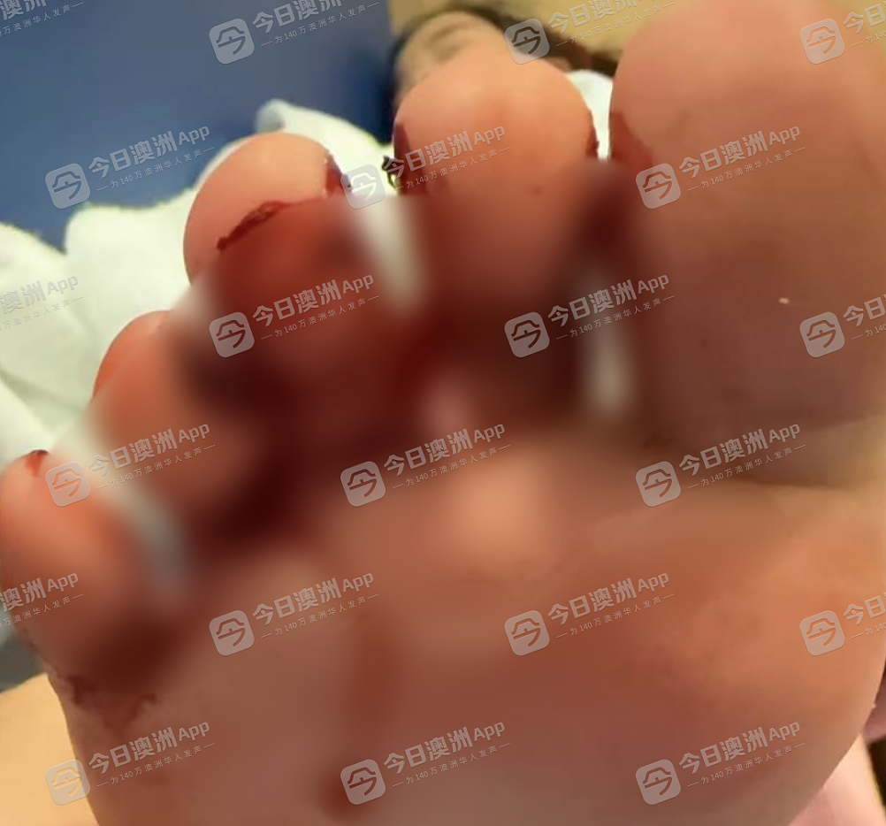 “肉都绽开了！”Chatswood商场扶梯割伤4岁华人女童，脚部鲜血淋漓！家长维权不畅，直至记者介入...（视频/组图） - 2