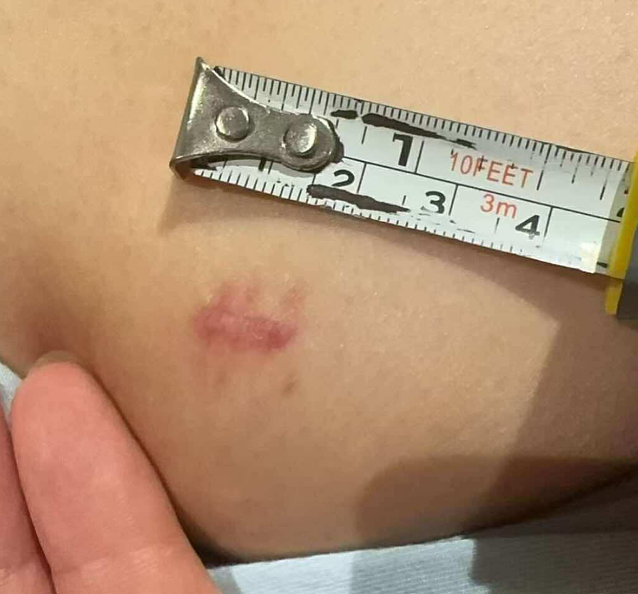 澳华女在CBD街头被随机捅伤!政府补助恐等半年,康复治疗全靠自掏腰包(组图) - 2