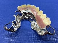  镶假牙  悉尼镶牙诊所 Bob Song Denture Clinic Parramatta Sydney removable dentures