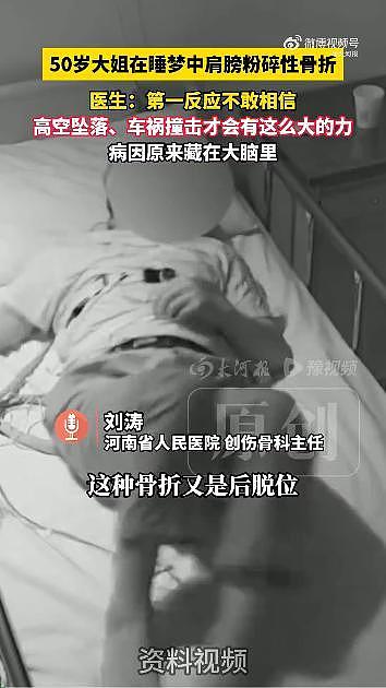 罕见！女子睡梦中肩膀粉碎性骨折，骨头碎成七八块，竟是这个原因...... - 1