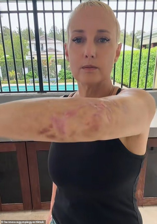 这种植物千万别碰!澳女偶遇“自杀树”,剧痛折磨四年仍未消减(组图) - 1