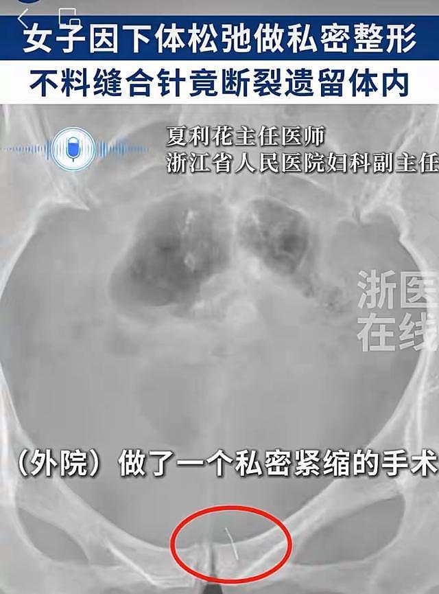 被吓到！35岁陈女士，花几万块买私处“紧致”，结果针断在里面了（组图） - 2