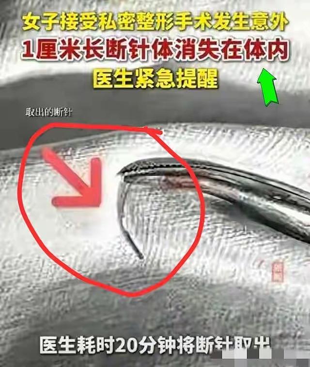 被吓到！35岁陈女士，花几万块买私处“紧致”，结果针断在里面了（组图） - 3