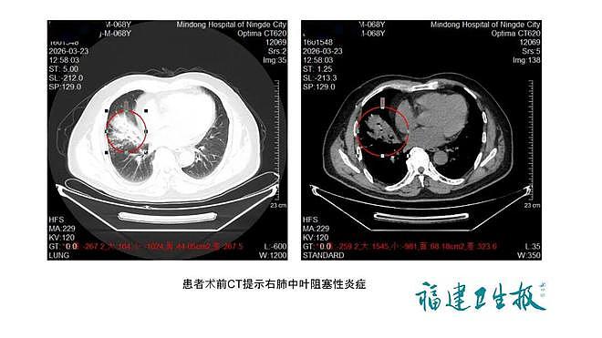 福建男子反复咳嗽两年，吃止咳药也不管用！医生一查惊了：你肺里有个…… - 1