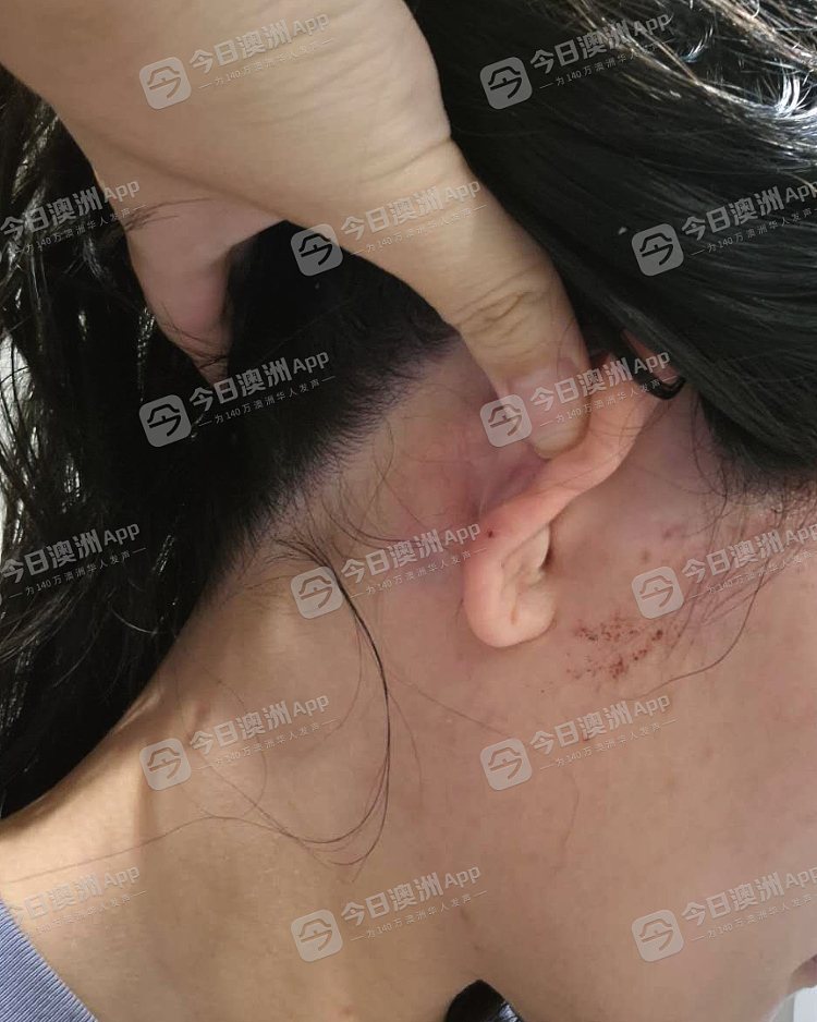 愤怒！澳洲华女遇种歧辱骂，被暴打至浑身是血，由救护车送院！悍妇更持刀威胁，一走了之（视频/组图） - 3