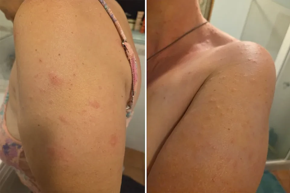 澳洲女护士丛林徒步后全身长满红斑，竟被600多只蜱虫钻入皮肤！ - 3
