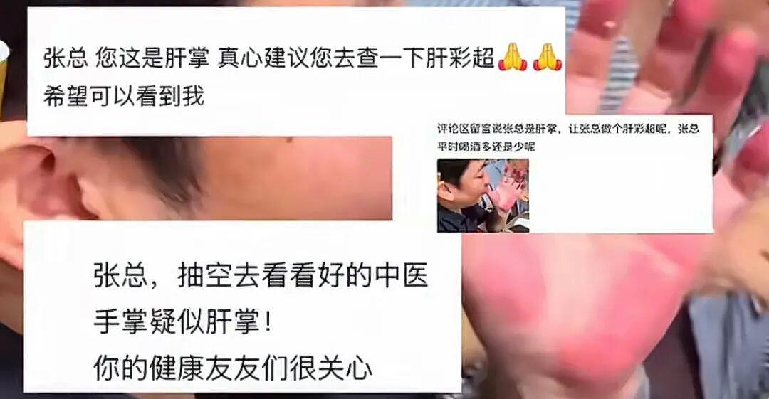张雪因手掌太红被网友提醒及时就医！此前回应：肝没问题（组图） - 2