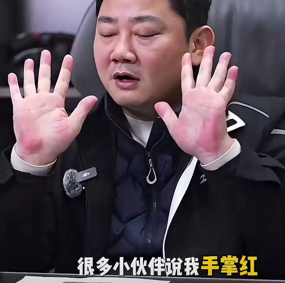 张雪因手掌太红被网友提醒及时就医！此前回应：肝没问题（组图） - 3