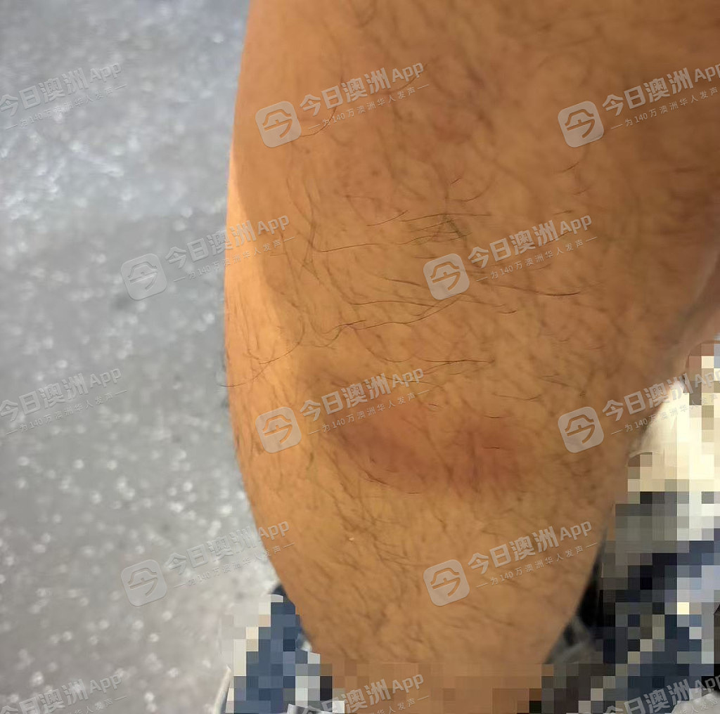 “今天要打死你！”澳洲华人送货司机曝遭中餐馆东主挥棍殴打，浑身是伤！老板娘：“诽谤！是一面之词”（组图） - 3