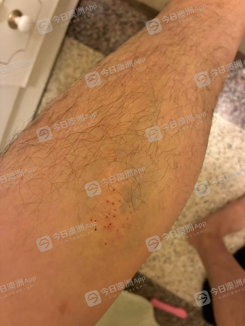 “今天要打死你！”澳洲华人送货司机曝遭中餐馆东主挥棍殴打，浑身是伤！老板娘：“诽谤！是一面之词”（组图） - 5