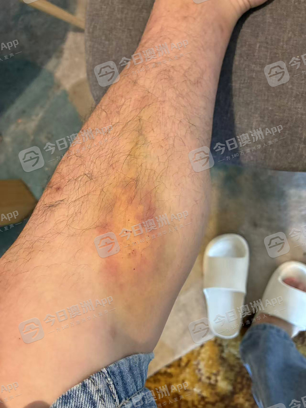 “今天要打死你！”澳洲华人送货司机曝遭中餐馆东主挥棍殴打，浑身是伤！老板娘：“诽谤！是一面之词”（组图） - 4