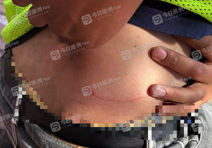 “今天要打死你！”澳洲华人送货司机曝遭中餐馆东主挥棍殴打，浑身是伤！老板娘：“诽谤！是一面之词”（组图） - 7