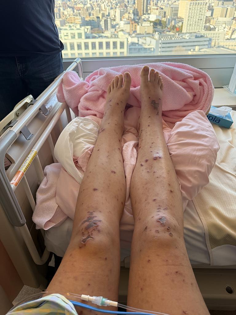 澳女日本旅游突发怪病,呕吐黑色液体且昏迷,医生紧急下达病危通知(组图) - 3
