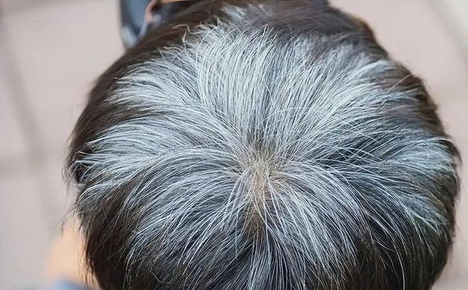 人一生得癌概率有多高？医生：头发早白的人，癌症风险或更低？（组图） - 4
