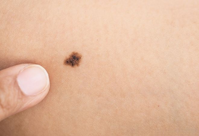人一生得癌概率有多高？医生：头发早白的人，癌症风险或更低？（组图） - 5