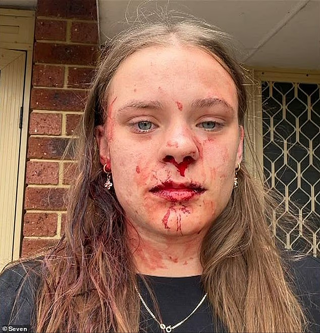 珀斯爆持刀入室案!少女在家遭两人暴打,鼻骨骨折,一度以为“活不过今晚”(组图) - 2
