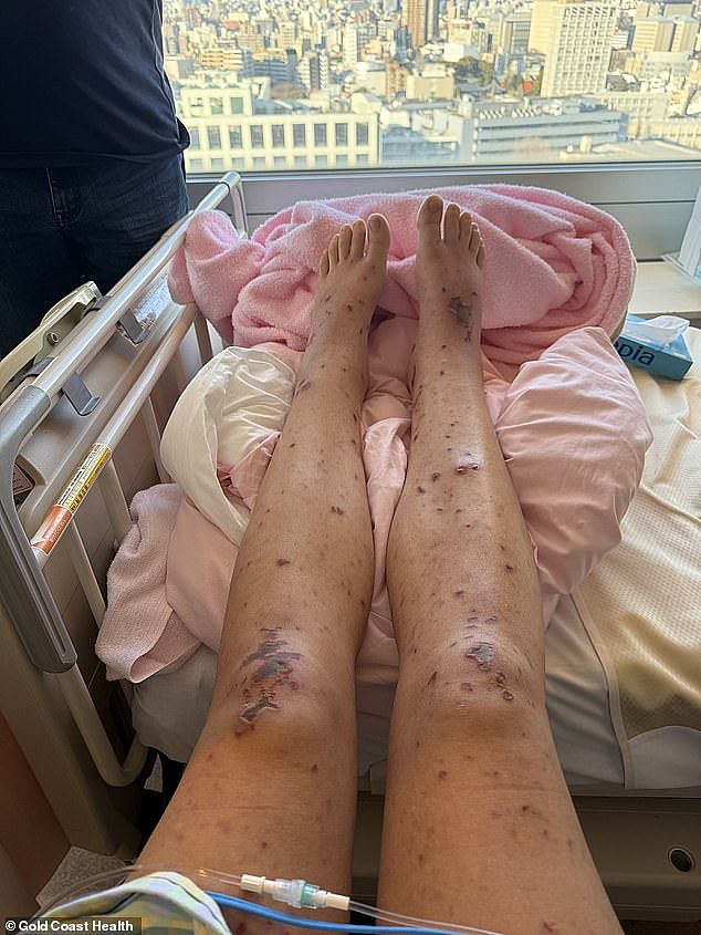 生死两小时！澳洲女孩赴日旅游染罕见病毒，昏迷3天险丧命，全身长满恐怖皮疹 - 2