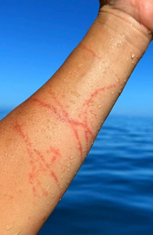 “我会不会死？”澳男斐济冲浪险丧命，惨遭最毒生物箱型水母蛰伤 - 2
