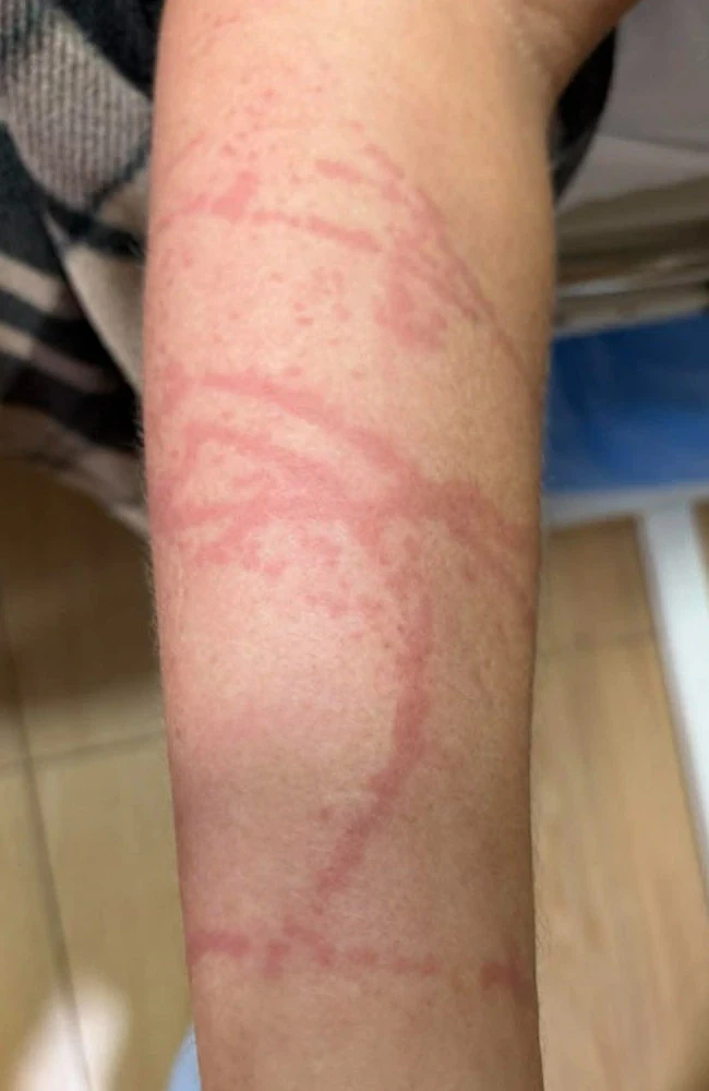 “我会不会死？”澳男斐济冲浪险丧命，惨遭最毒生物箱型水母蛰伤 - 4
