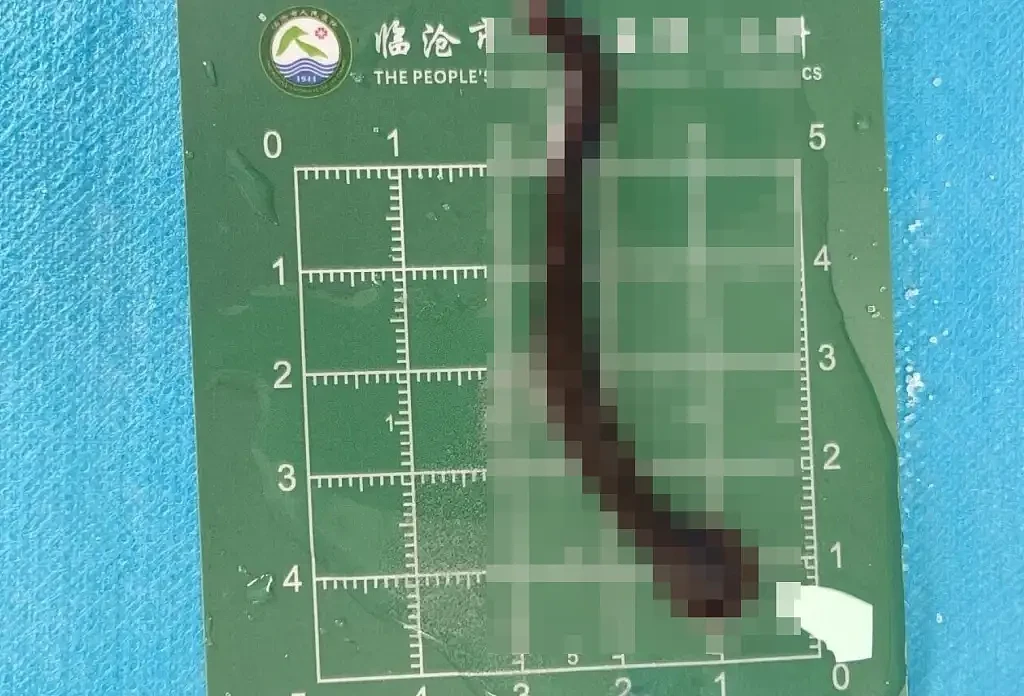 云南一幼童气管内取出8厘米活体蠕动蚂蟥（组图） - 2