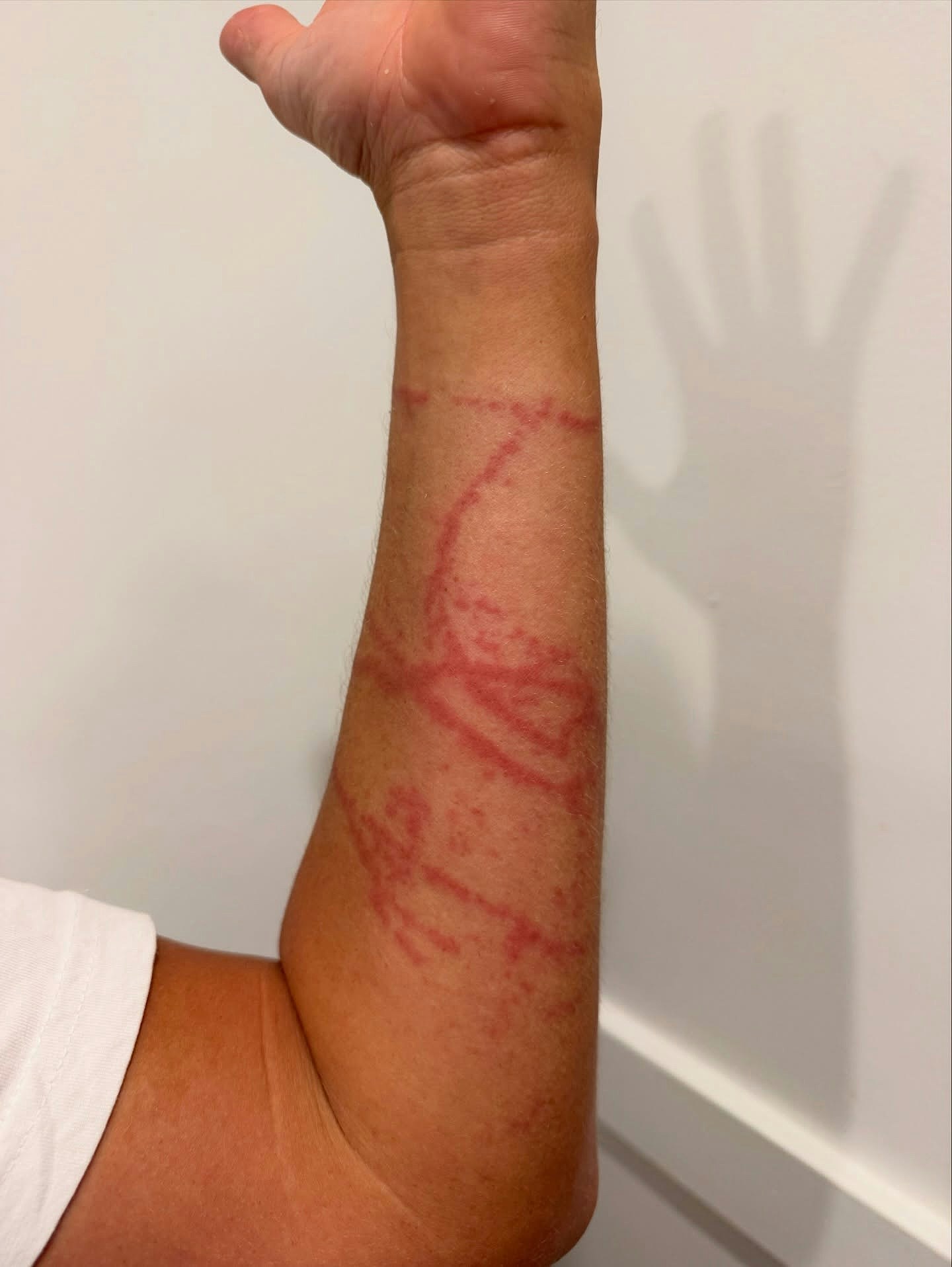 澳洲男遭最毒水母螫伤,手臂痛如被滚油辣!绝望留遗言竟奇迹存活(组图) - 5