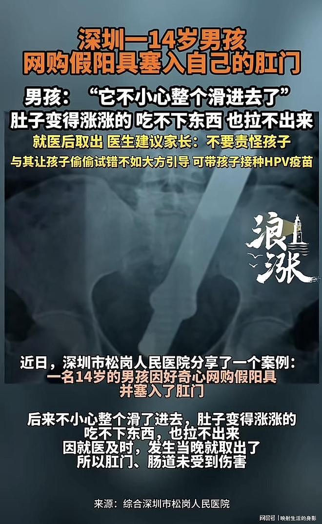 14岁男孩网购假阳具塞入肛门后拿不来，医生：家长别责怪孩子（组图） - 1