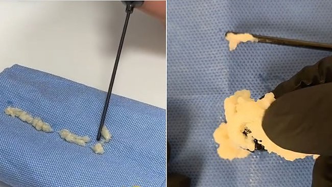 把死者的脂肪打进自己体内?新型医美“僵尸填充物”爆红,澳专家警告(组图) - 3