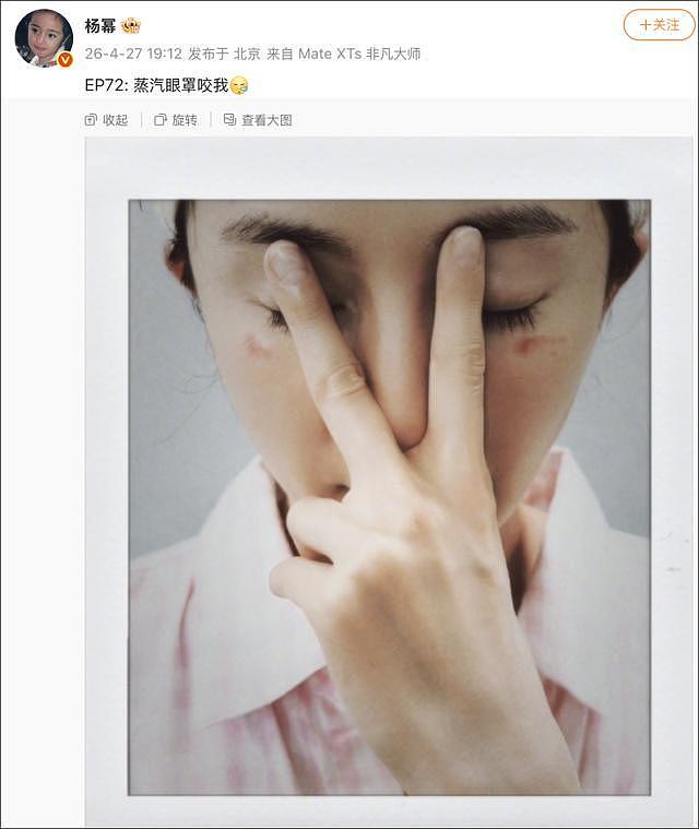 杨幂晒照被烫伤！网友：“再也不敢戴着睡觉了……” 专家：严格控制在20分钟内 - 1