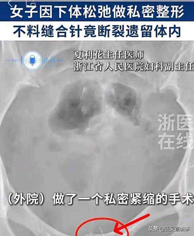 35岁女子去做私处紧缩，缝针断在肉里，医生徒手掏了半小时没找着 - 6