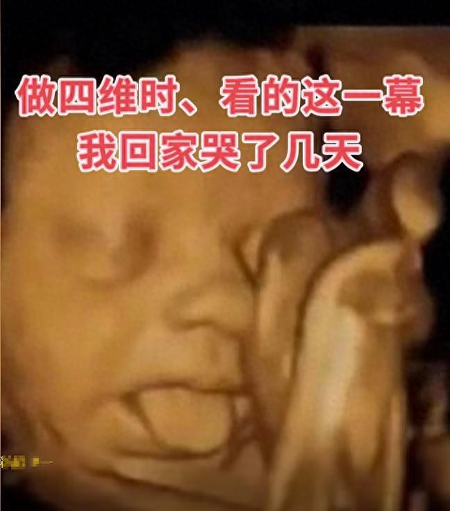 B超里胖胎宝直吐舌头，老公直呼可爱！医生一句话让夫妻崩溃了 - 1